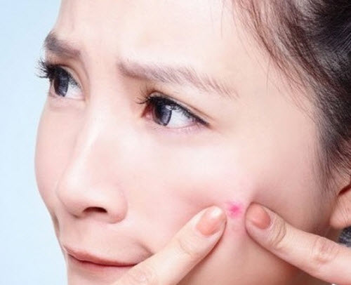 TỔNG QUAN VỀ MỤN
