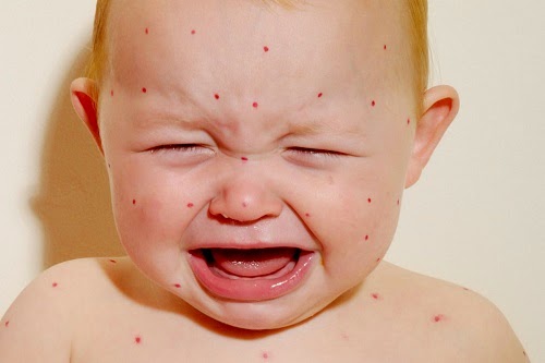 7 Bệnh Da Ở Trẻ Em Vào Mùa Hè