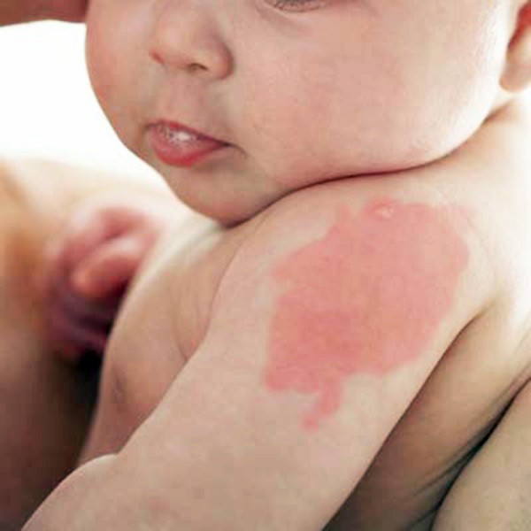 Chàm Da Và Bệnh Chàm Ở Trẻ Em