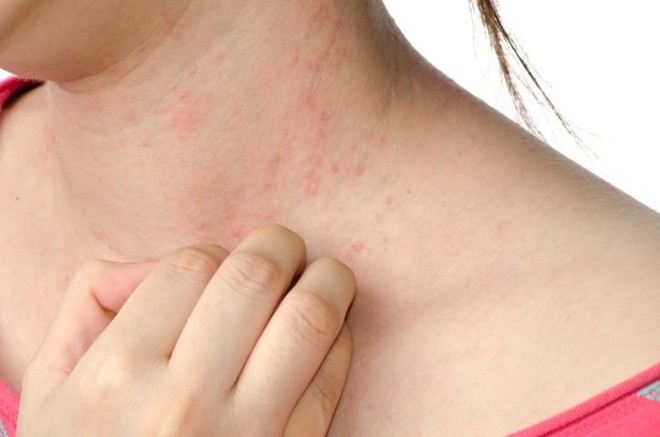 Cách đối phó với hiện tượng viêm da dị ứng tiếp xúc