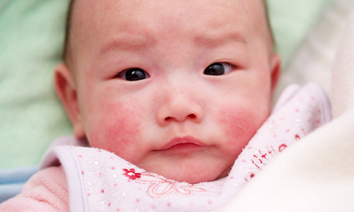 Bệnh Viêm Da Dị Ứng Ở Trẻ Em Vào Mùa Đông