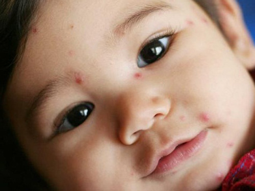 Bệnh Thủy Đậu Ở Trẻ Nhỏ - Nguyên Nhân Và Cách Điều Trị