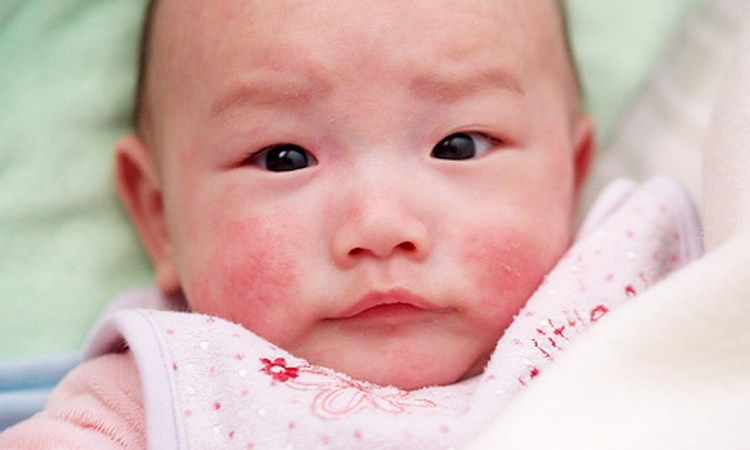 Viêm Da Dị Ứng Ở Trẻ Em