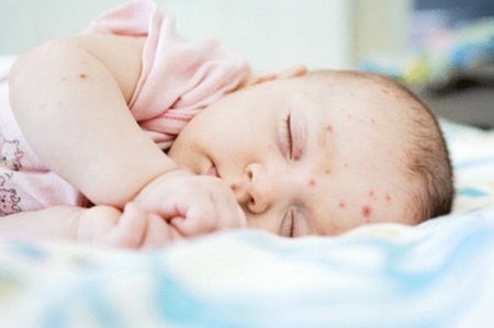 Mụn Nhọt Ở Trẻ Em - Cách Chữa Trị Hiệu Quả