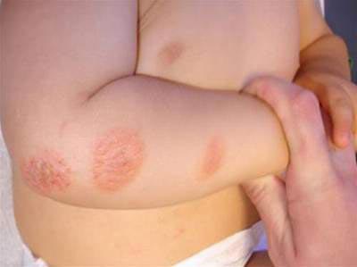 Bệnh Vảy Nến Ở Trẻ Em - Cách Điều Trị