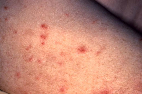 BỆNH QUA ĐƯỜNG TÌNH DỤC – PHÁT HIỆN SỚM, ĐIỀU TRỊ SỚM