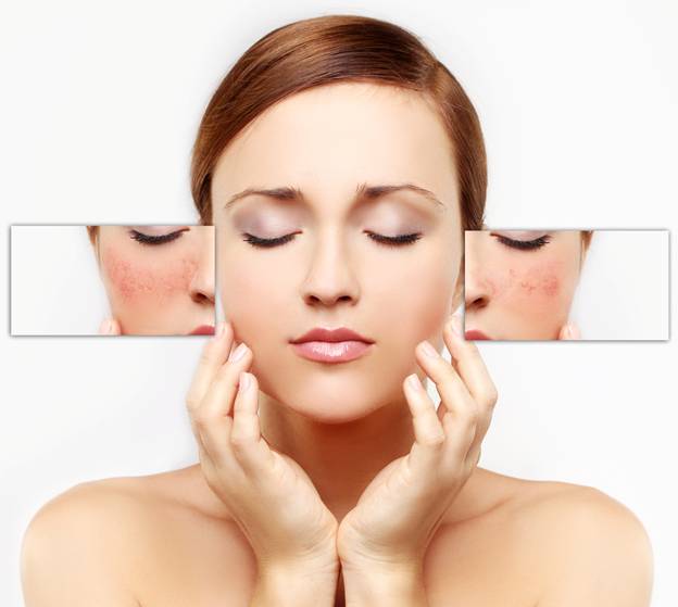 GIẢI QUYẾT TRIỆT ĐỂ NỖI LO NÁM DA
