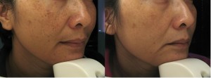 TÀN NHANG, ĐỒI MỒI, NÁM DA VÀ NHỮNG ĐIỀU CẦN BIẾT