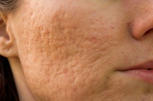 LÀM SAO ĐỂ HẾT SẸO RỖ TRÊN MẶT