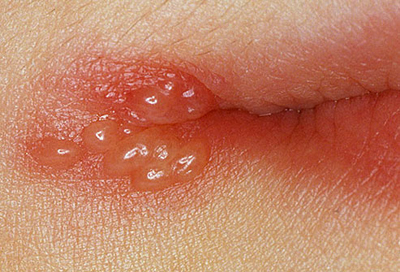 CHỨNG MỤN GIỘP (HERPES)