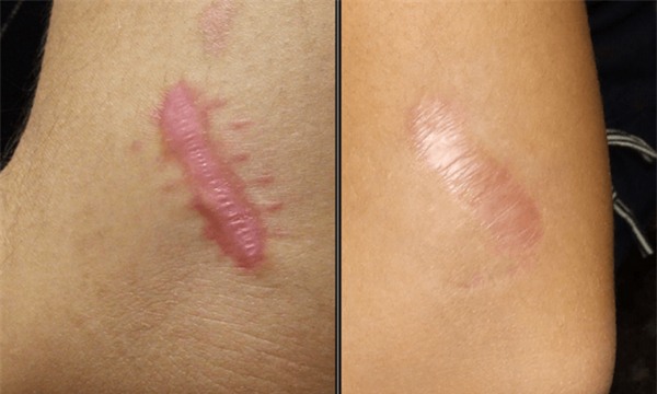 Xóa sẹo lồi cứng đầu, quá đơn giản với những nguyên liệu sau đây