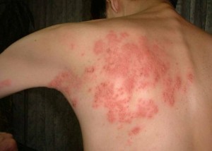 BỆNH GIỜI LEO – CÓ THỂ BẠN CHƯA BIẾT!