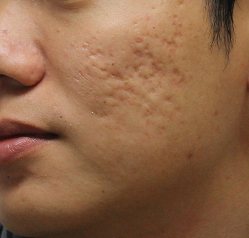 Mẹo điều trị sẹo rỗ lâu năm trên mặt an toàn tuyệt đối 