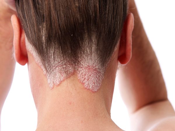 Vị trí trên cơ thể giúp dễ phát hiện ung thư da