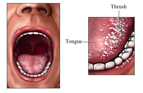 Nấm Candida (Đẹn) Của Trẻ Sơ Sinh