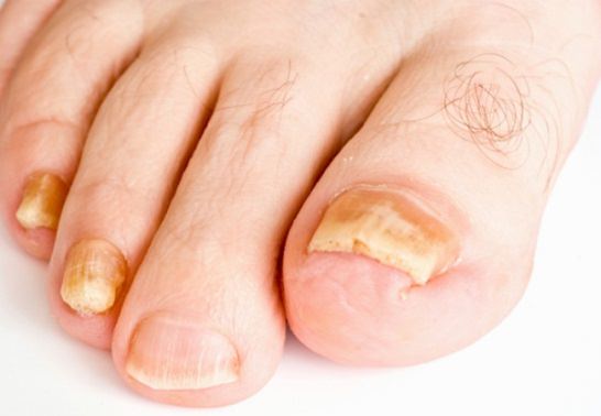 ĐIỀU TRỊ BỆNH NẤM MÓNG TẬN GỐC