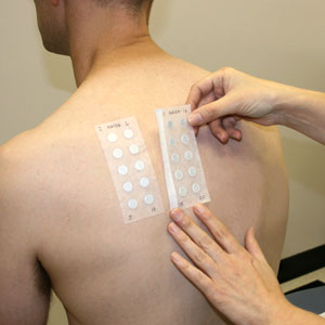 Patch Test: Chuẩn Đoán Bệnh Viêm Da Tiếp Xúc Dị Ứng