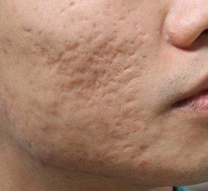 Điều Trị Sẹo Mụn