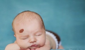 Trị Bớt Bẩm Sinh